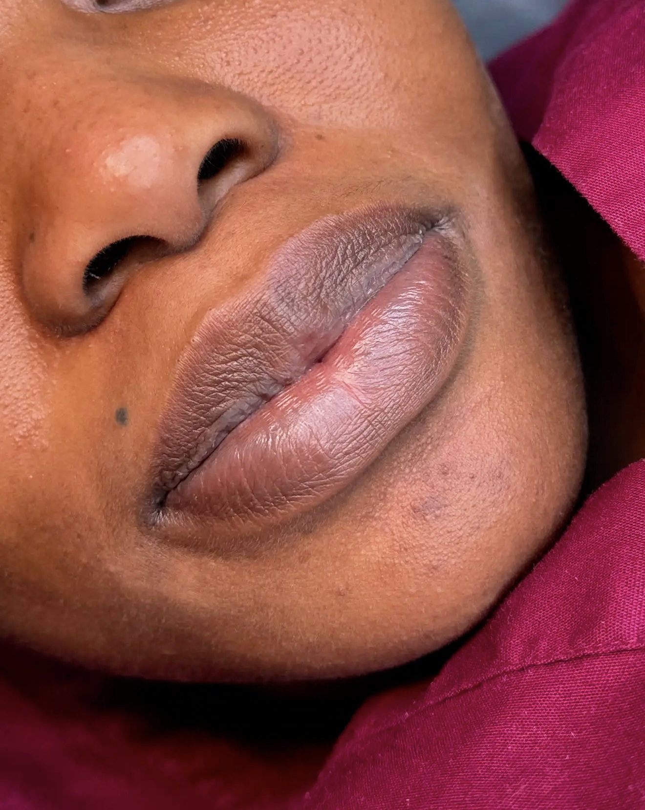 Lip Neutralization — Before