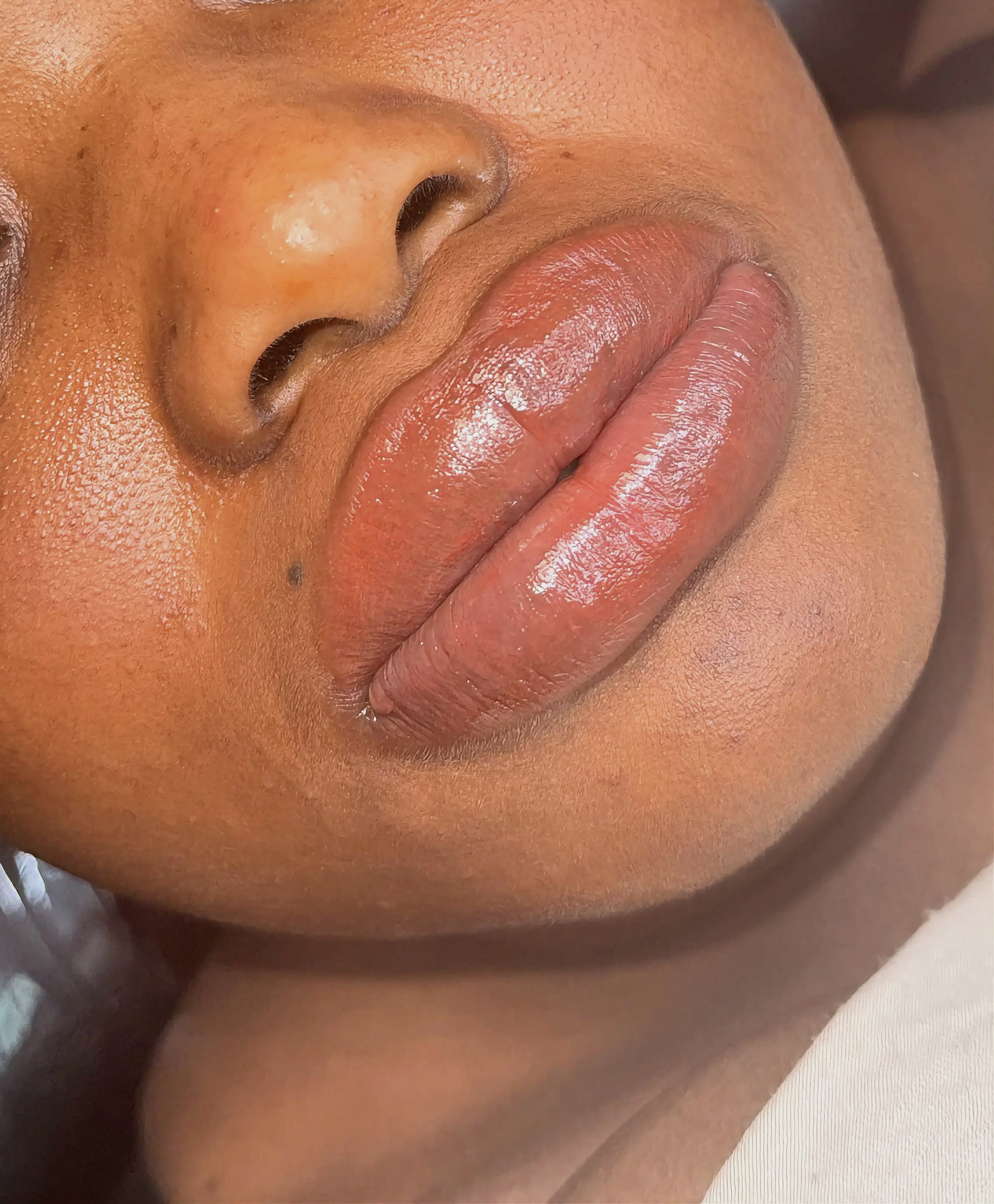 Lip Neutralization — After