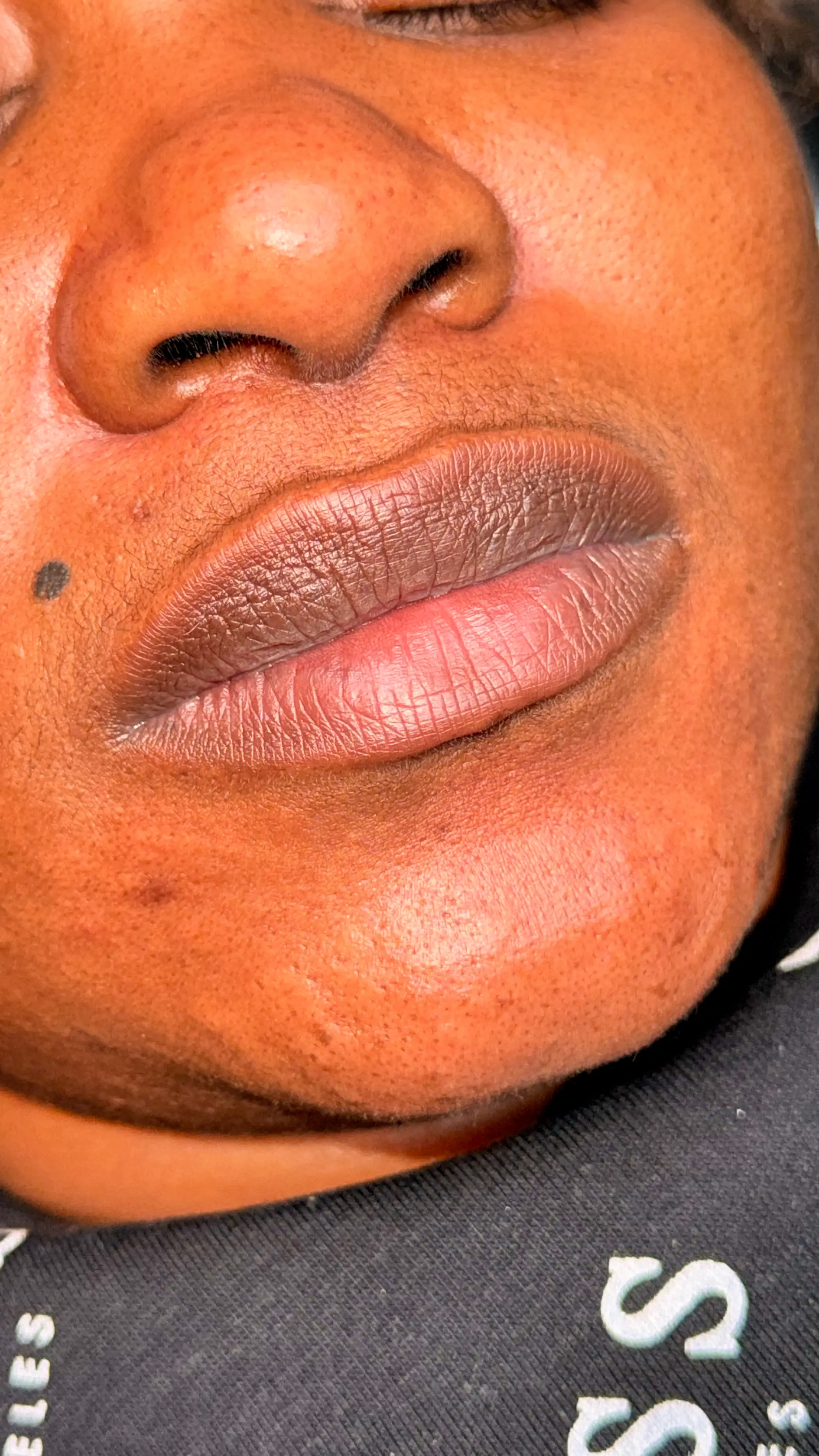 Lip Neutralization — Before