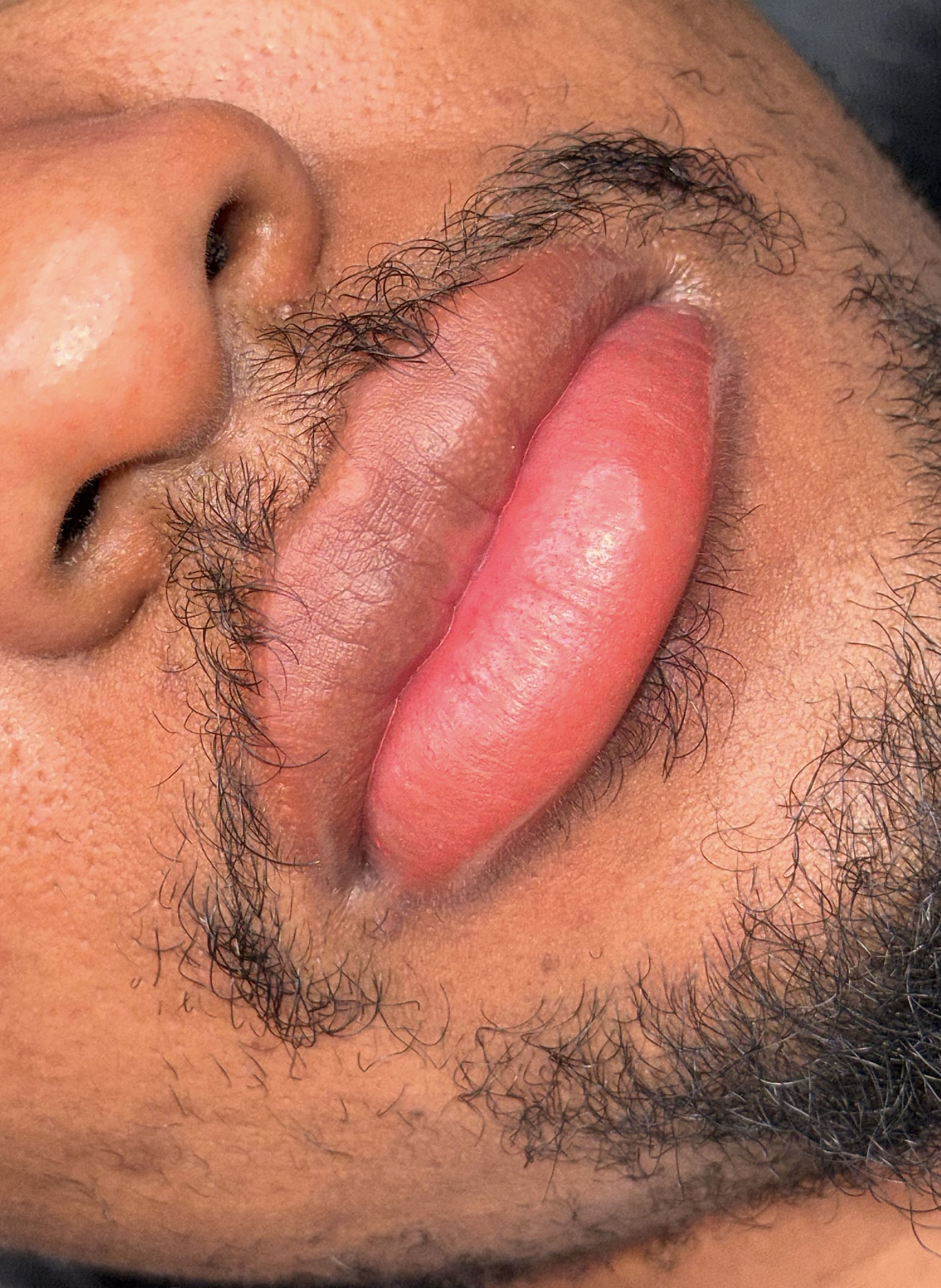 Lip Neutralization — After
