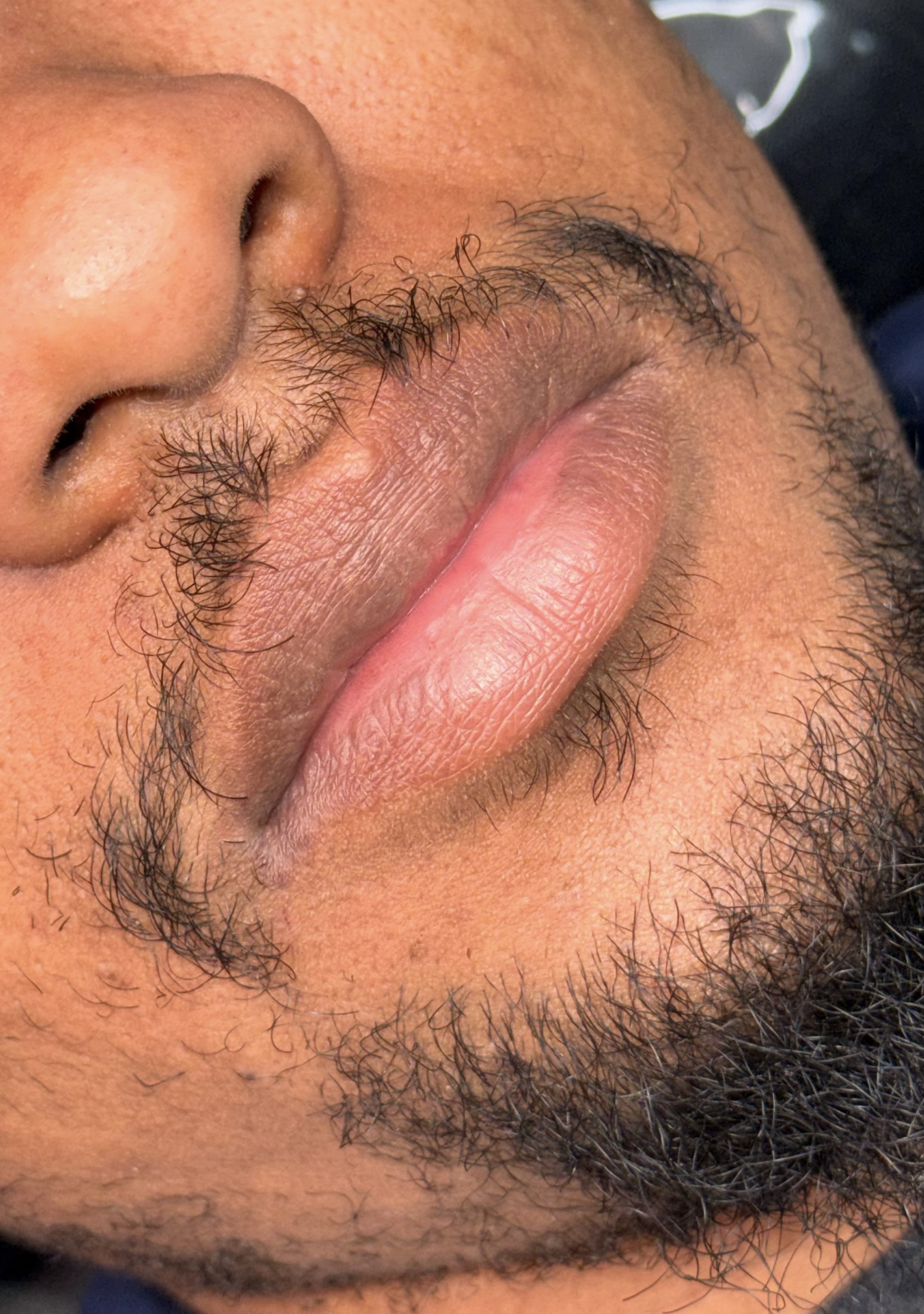 Lip Neutralization — Before